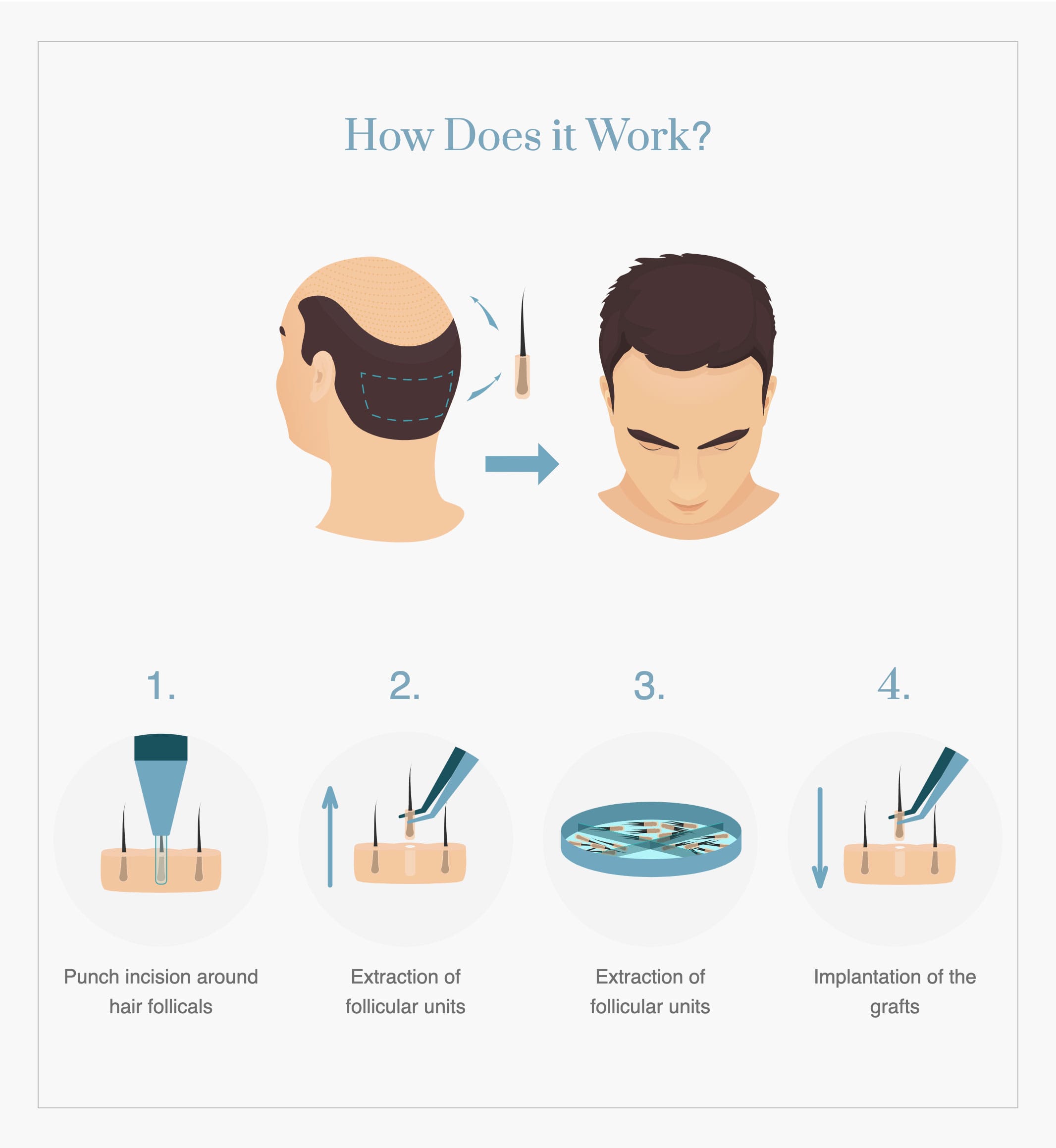 Hair Restoration Process