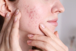 woman with acne on cheek